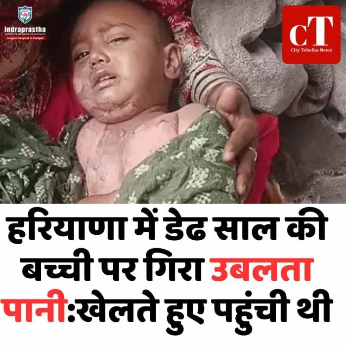 हरियाणा में डेढ़ साल की बच्ची उबलते पानी की चपेट में, पेट और हाथ-पैर झुलसे