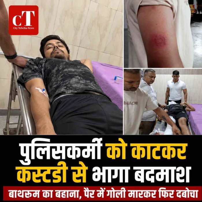 पुलिसकर्मी को काटकर कस्टडी से भागा बदमाश, पैर में गोली मारकर फिर दबोचा